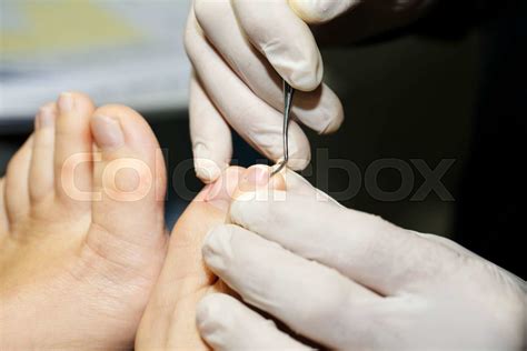 Dermatologist Makes Inspection Nail Fungus Stock Image Colourbox