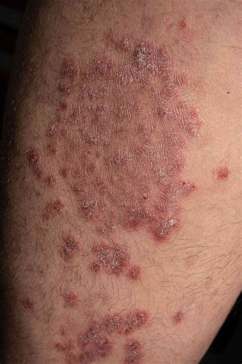 Guttate Psoriasis Symptoms Pictures And Treatment