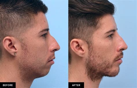 Jawline Filler For Definition Contour Updated Mabrie Facial