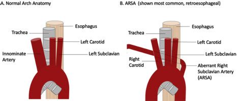 Right Aortic Arch With Aberrant Left Subclavian