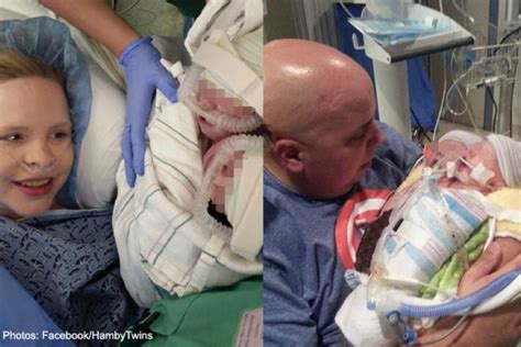 Rare Conjoined Twins Die At Georgia Hospital A Day After Birth Health