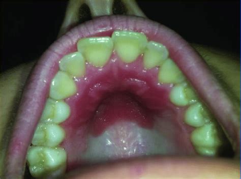 Erythematous Flat Lesion On The Anterior Hard Palate The Edges Are
