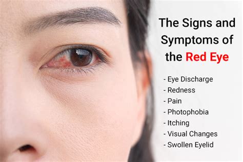 Red Eyes Causes Symptoms Diagnosis And Treatment