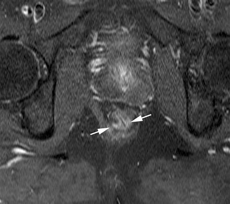 Anatomic And Pathologic Findings At External Phased Array Pelvic Mr