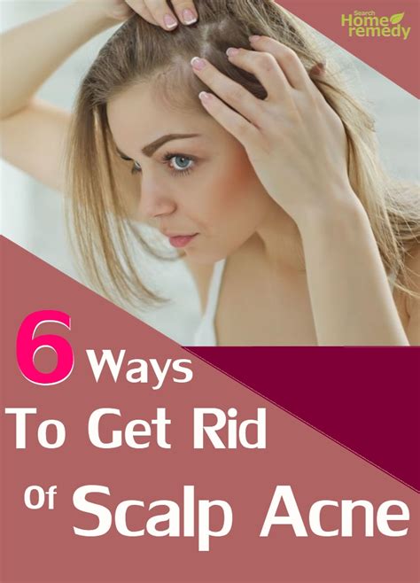 6 Ways To Get Rid Of Scalp Acne Search Home Remedy