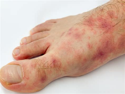 Covid Skin Rashes From Purple Toes To Hives And Eczema How To Deal