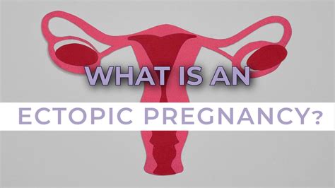 Ectopic Pregnancy Symptoms Causes And Treatment Youtube