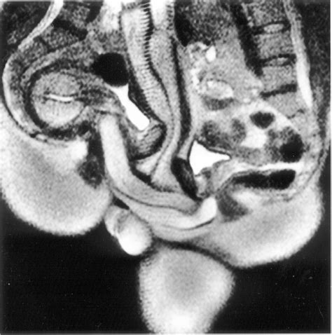Magnetic Resonance Diagnosis Of Posterior Horn Tears Of The Lateral
