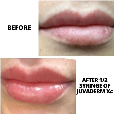 Windsor Juvederm Lip Filler Treatment Medical Cosmetics