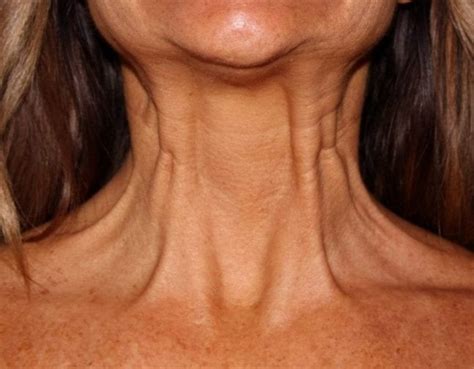 Neck Botox Before And After Photos Rejuva Center