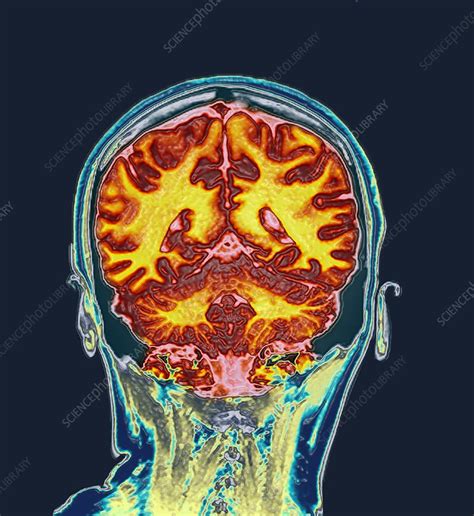 Healthy Brain Mri Scan Stock Image C0499308 Science Photo Library
