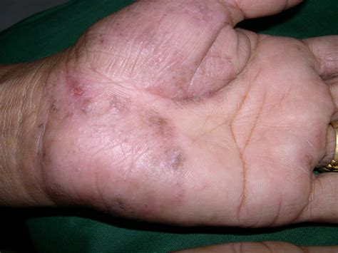 Tinea On Hand Pictures Photos