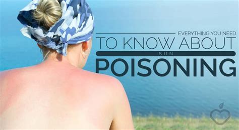 Everything You Need To Know About Sun Poisoning