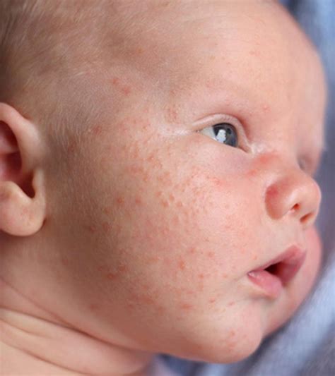 Baby Acne Causes Symptoms And How To Get Rid Of It