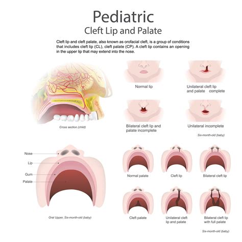 Treating Cleft Palate In Speech Therapy