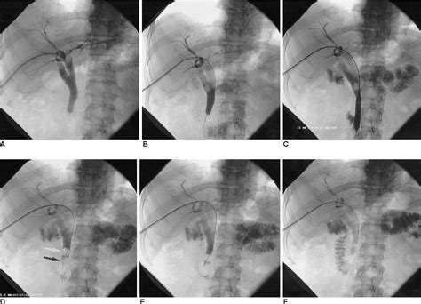 Pdf Percutaneous Treatment Of Extrahepatic Bile Duct Stones Assisted