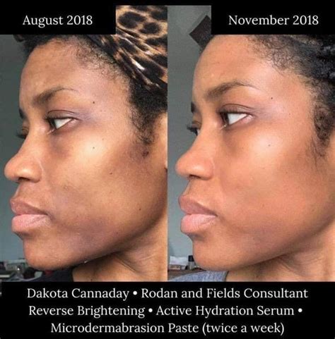 Pin By Shannon Trisler On Rodan And Fields For African American Skin Microdermabrasion Paste
