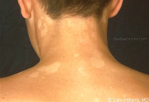 Tinea Versicolor Pictures Symptoms Causes Natural Treatment