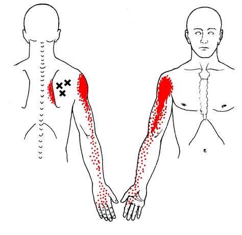 What Are Trigger Points — Plus Forte Physical Therapy