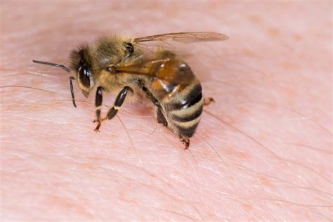 Serious Allergic Reactions To Wasp And Bee Stings Increase By 20