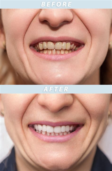 How Can Dental Treatments Make You Look Younger