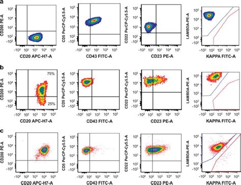 Examples Of Cd200 Expression In Mantle Cell Lymphoma By Flow Cytometry