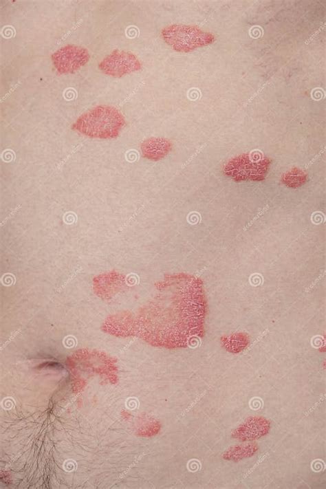 Psoriasis Vulgaris Skin Patches Are Typically Red Itchy And Scaly