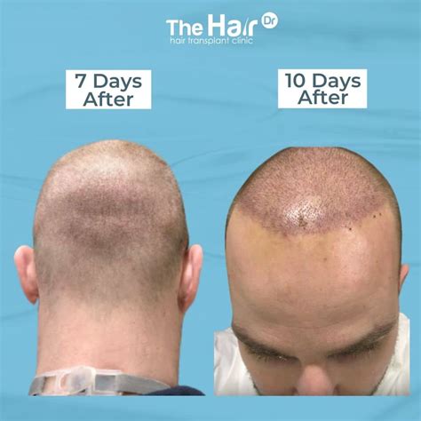 Aggregate 75 7 Days After Hair Transplant Ineteachers