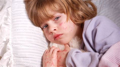 Toddler Itchy Red Bumps On Skin Jameslemingthon Blog