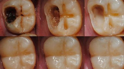How To Regrow Teeth Teethwalls