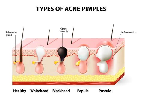 Talgdrüse Types Of Acne Antibiotics For Acne Acne Causes