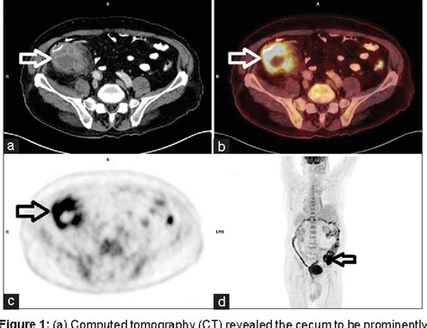 Figure 1 From A Case Of Plastron Appendicitis Mimicking Malignant Cecal