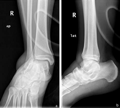 A Anteroposterior Ankle X Ray Of The Involved Lower Extremity A