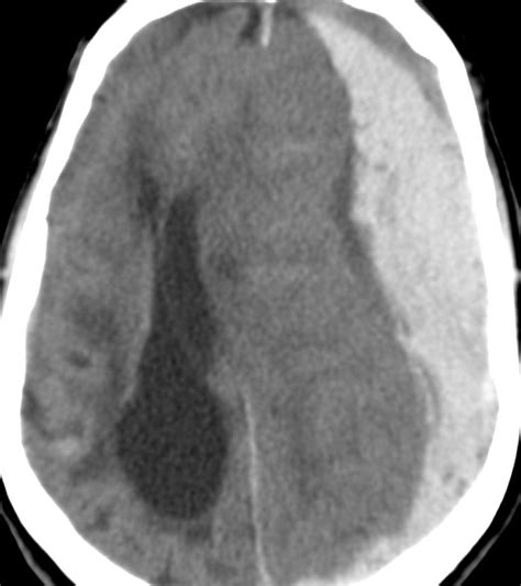 Subdural Hematoma Sdh The Neurosurgical Atlas