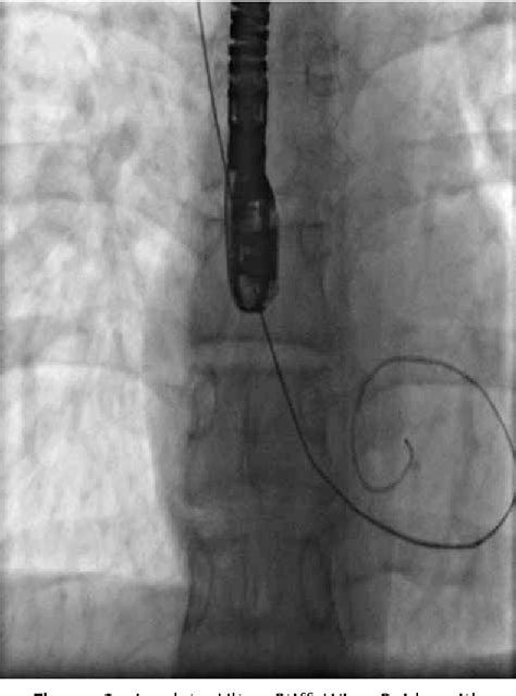 Figure 7 From Transcatheter Closure Of Patent Foramen Ovale Using The
