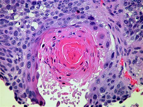 Squamous Cell Carcinoma Scc Sqcc Lecturio Online Medical Library