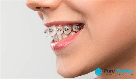 How Can Braces Correct An Overbite