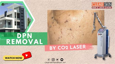 Dpn Removal Treatment By Co2 Laser Best Laser Removal For Dermatosis