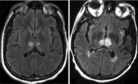 Current Differential Diagnoses And Treatment Options Of Vascular