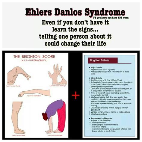 Ehlers Danlos Syndrome Education