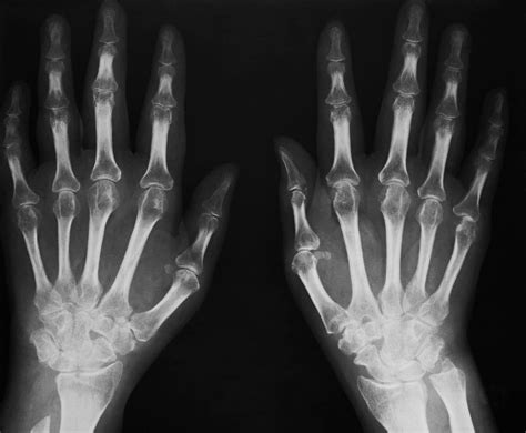 Arthritic Hands X Ray Photograph By Antonia Reevescience Photo Library