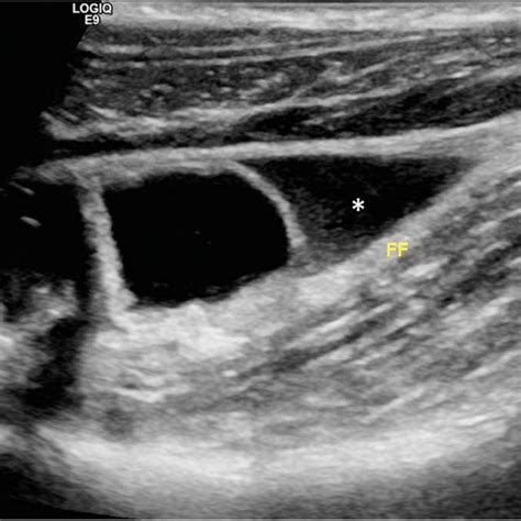 Normal Appendix In A Year Old Babe Longitudinal Ultrasound Image Download Scientific Diagram