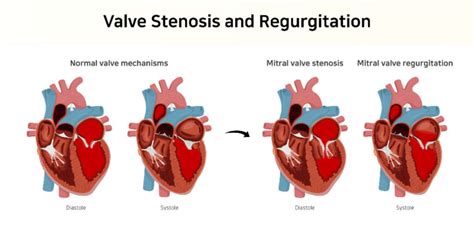 Mitral Valve Diseases Types Symptoms And Treatment Dr Raghu