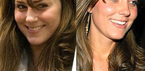 Kate Middleton Nose Job Before And After