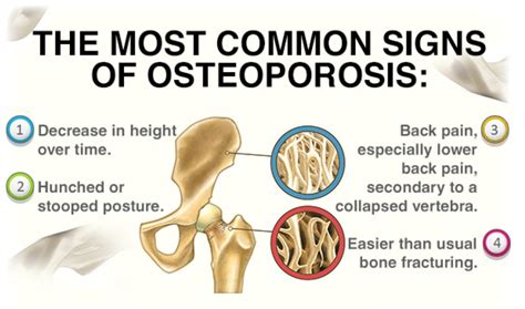 Group5presentation1 Osteoporosis Wiki