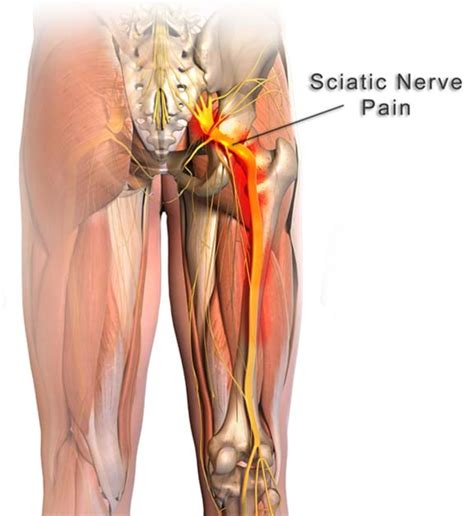 The nerve irritation or compression activates the sciatic nerve and causes pain and other symptoms down the leg on the path of the affected nerve, he says. Chiropractic Solutions|Norwood|Sciatica and Disc Injuries