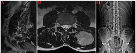 A Localized Mass Lesion In The Posterior Of The L 3 Vertebral Corpus