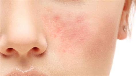 Rhofade A Topical Treatment To Target Rosacea Has Just Been Approved