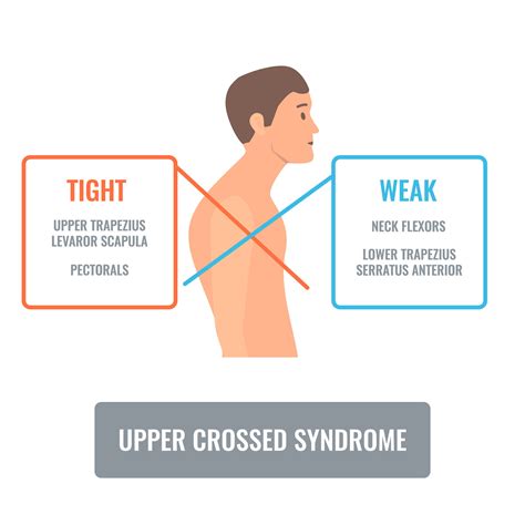 Upper Crossed Syndrome Seattle Clinical Massage School