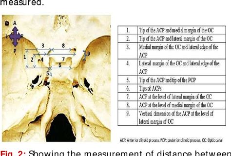 Pdf Morphometry Of Anterior Clinoid Process A Cadaveric Study
